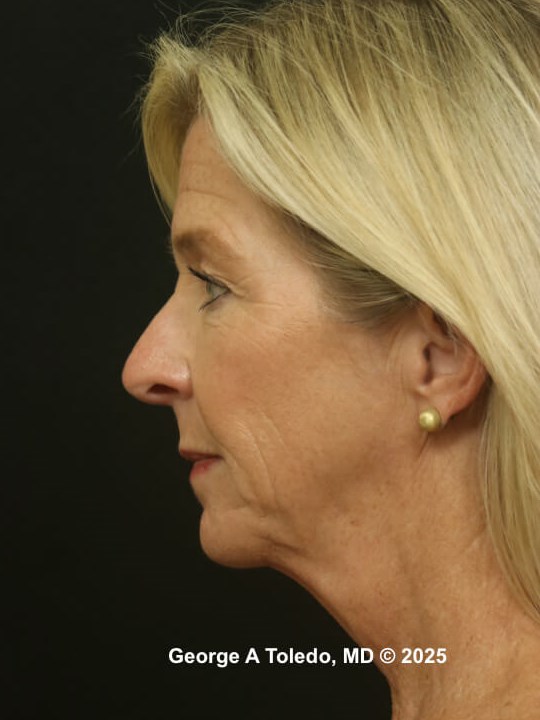 Facial Rejuvenation Results Before