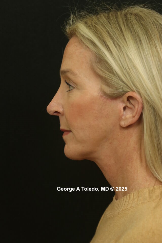 Facial Rejuvenation Results After