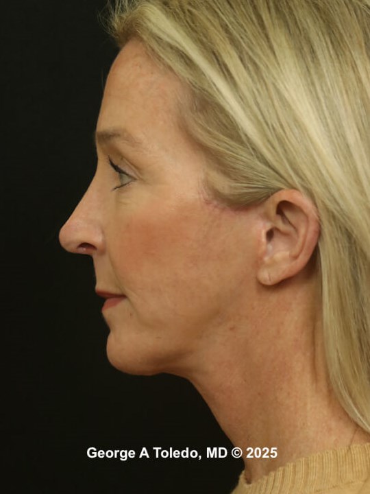 Facial Rejuvenation Results After