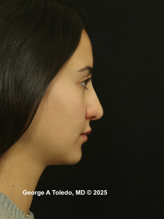 Revision Rhinoplasty Results Before