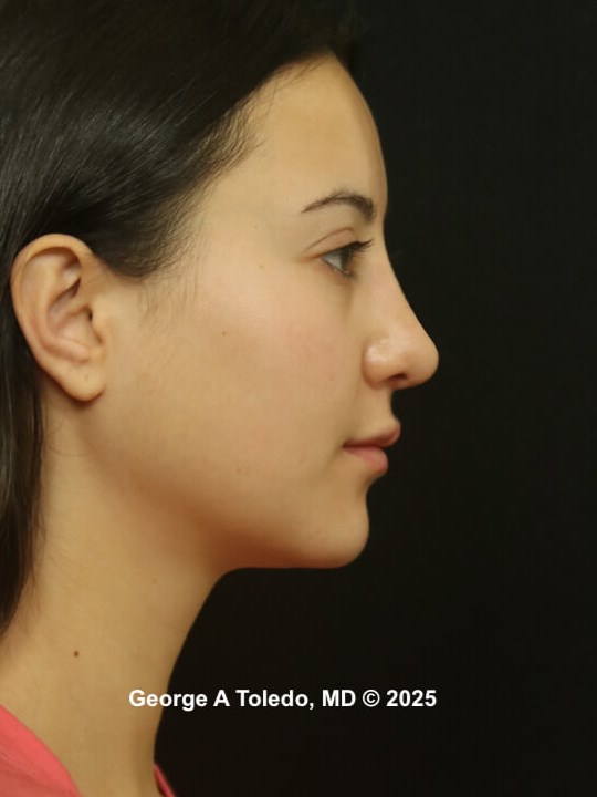 Revision Rhinoplasty Results After