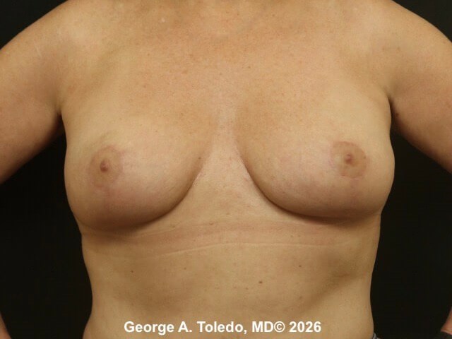 Breast Reduction Results After