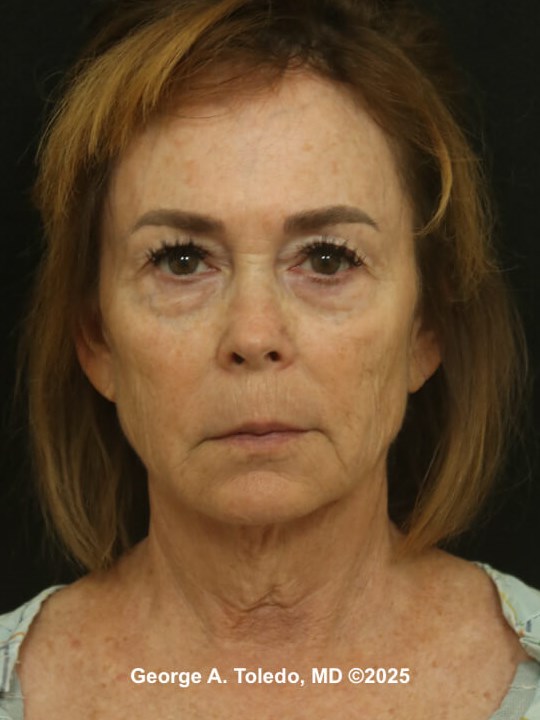 Facial Rejuvenation Results Before