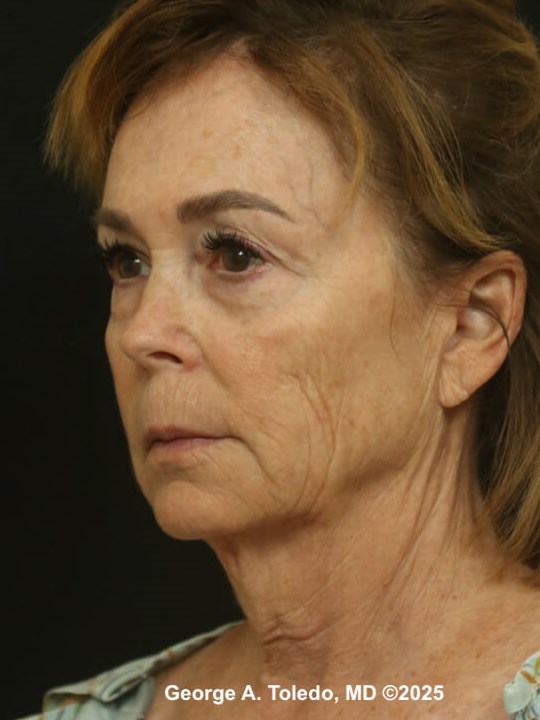 Facial Rejuvenation Results Before