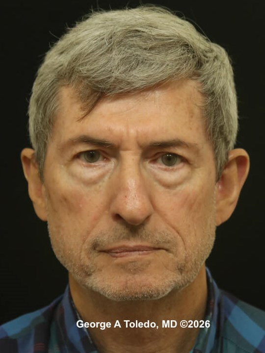 Lower Eyelid Surgery Results Before