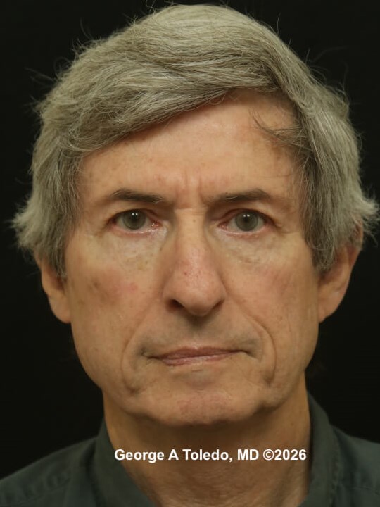 Lower Eyelid Surgery Results After