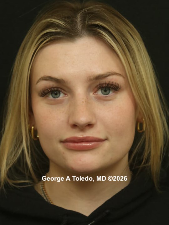 Rhinoplasty Before and After Before