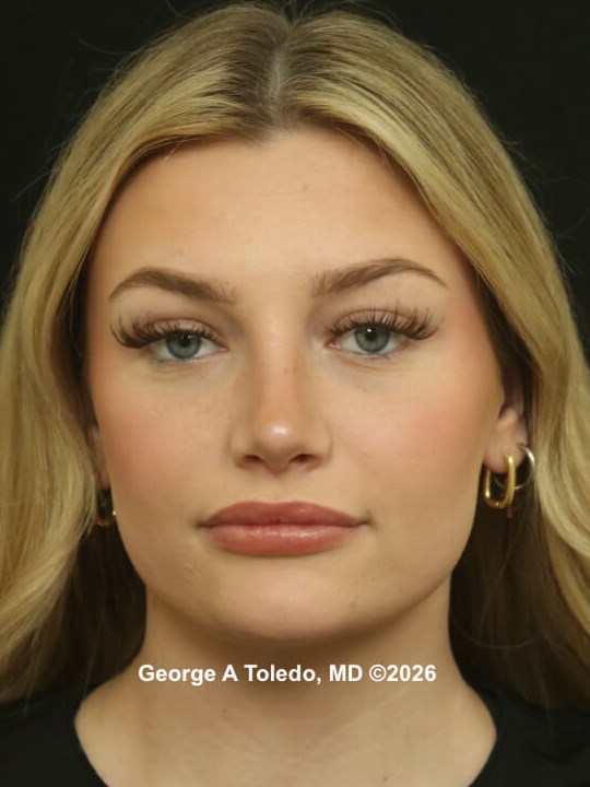 Rhinoplasty Before and After After