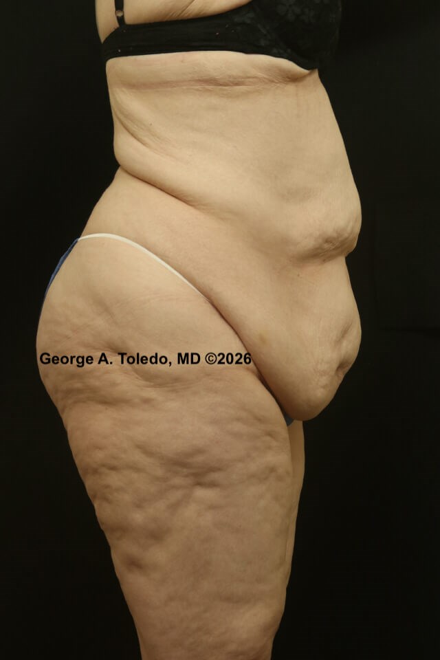 Tummy Tuck Before and After Before