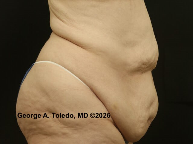 Tummy Tuck Before and After Before