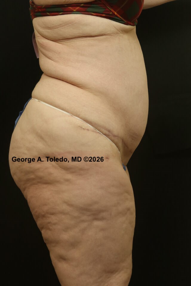 Tummy Tuck Before and After After