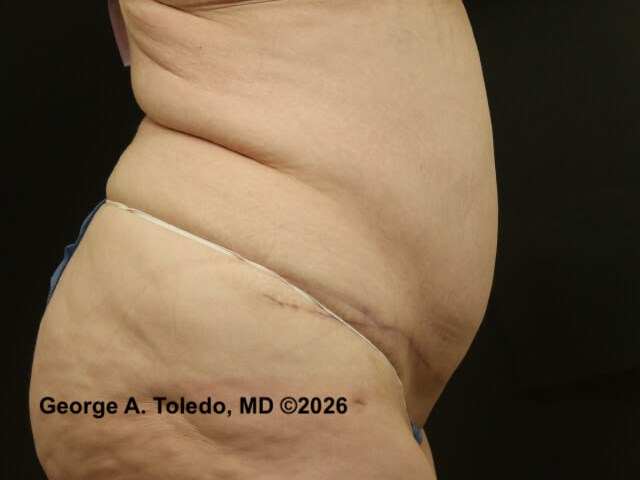 Tummy Tuck Before and After After