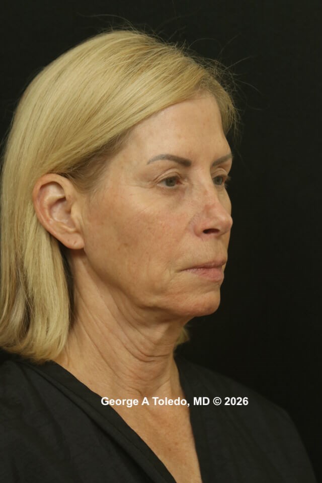 Facelift, Revision Rhinoplasty Before
