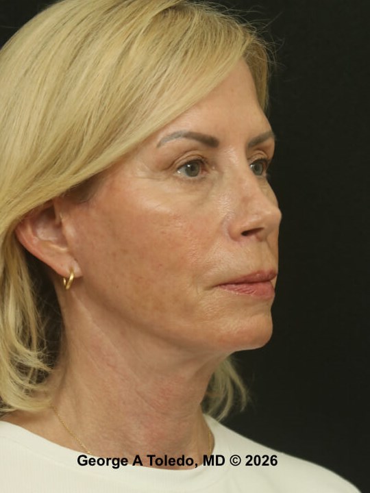 Facelift, Revision Rhinoplasty After