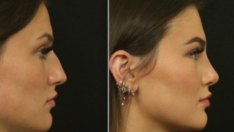 Profile Rhinoplasty