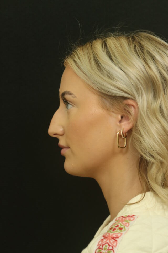 Rhinoplasty Results Before