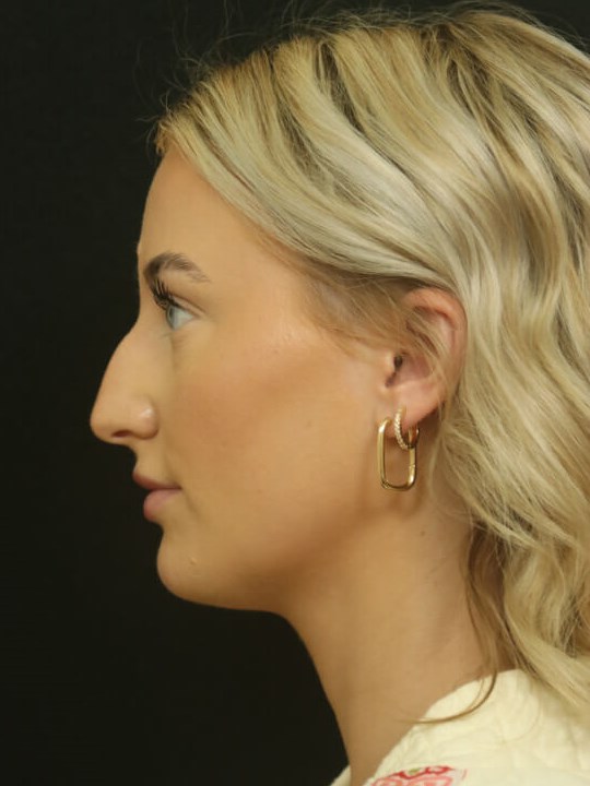 Rhinoplasty Results Before