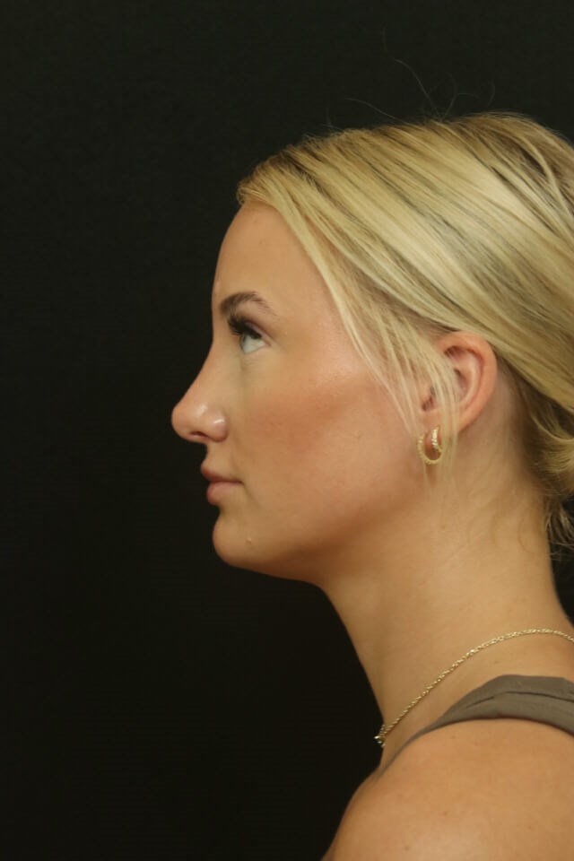 Rhinoplasty Results After