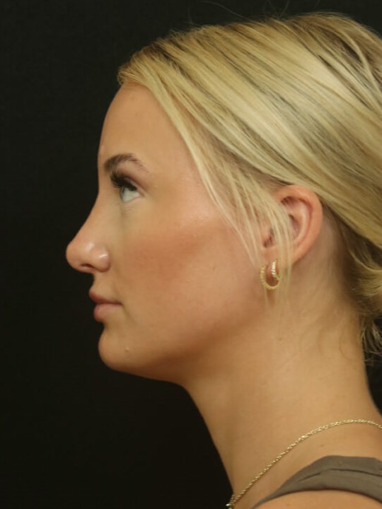 Rhinoplasty Results After