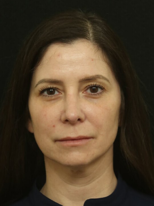 Revision Rhinoplasty Results After