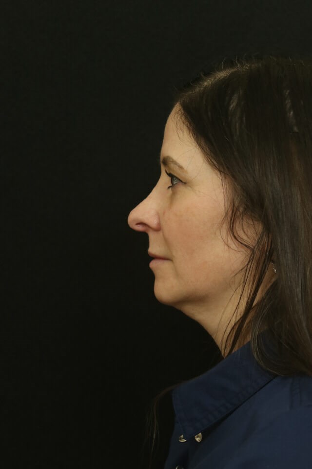 Revision Rhinoplasty Results Before