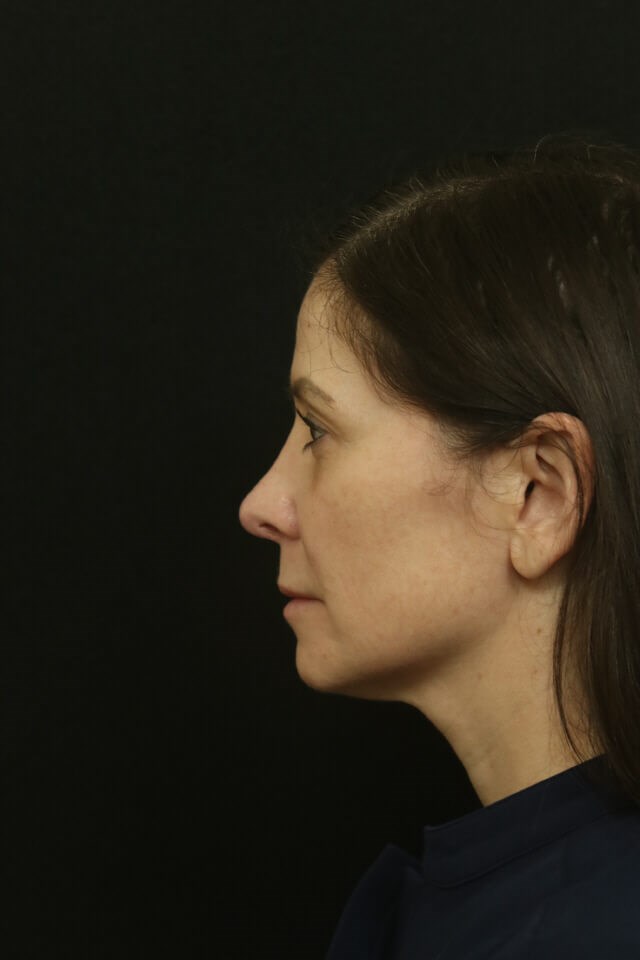 Revision Rhinoplasty Results After
