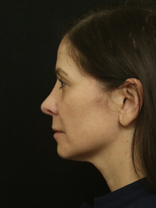 Revision Rhinoplasty Results After