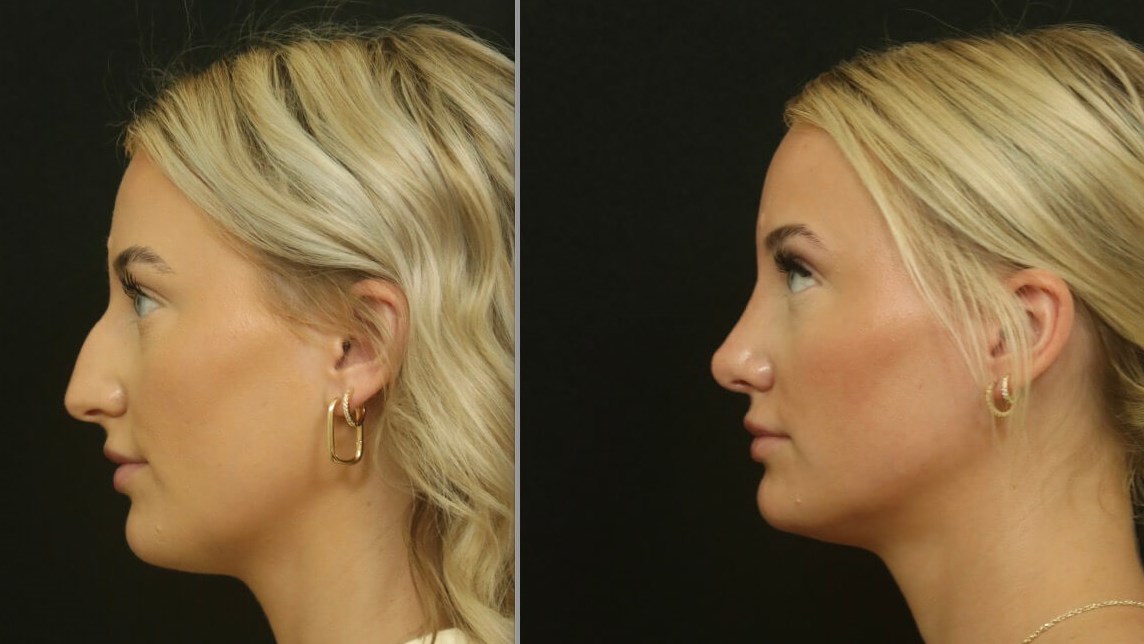 Rhinoplasty Results