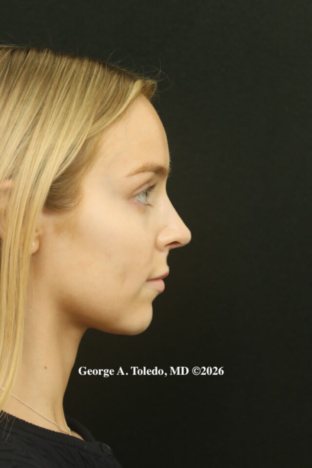 Rhinoplasty Results After