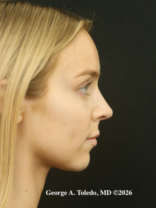 Rhinoplasty Results After