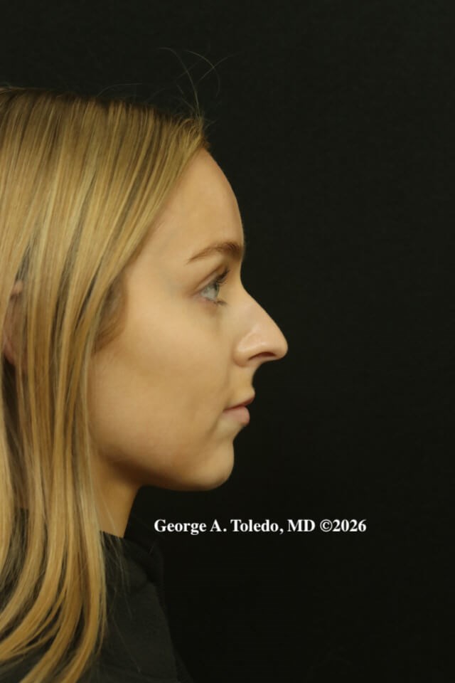 Rhinoplasty Results Before