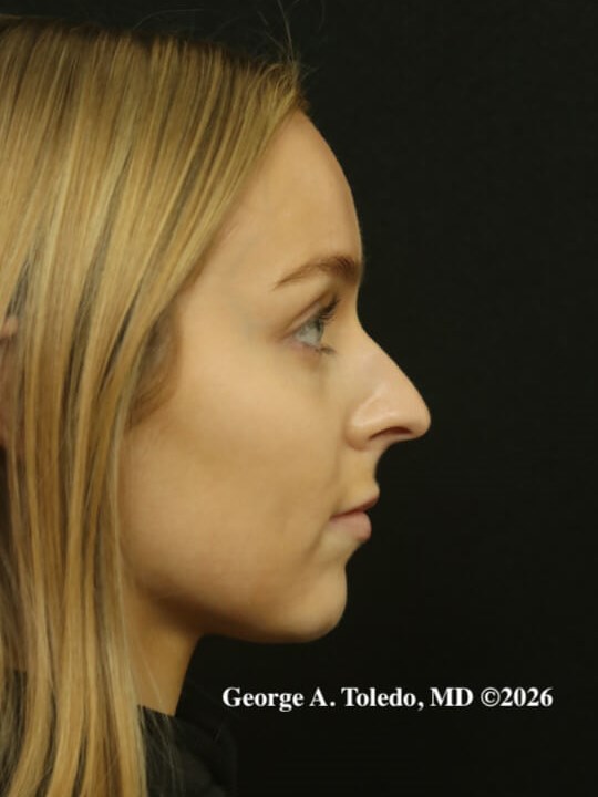 Rhinoplasty Results Before