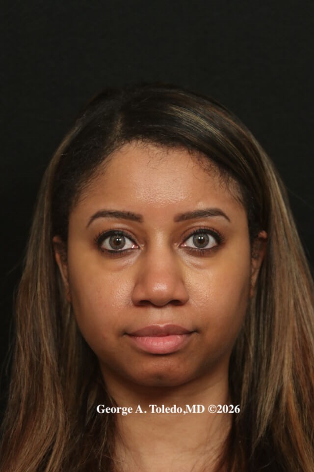 Ethnic Rhinoplasty Dallas Before