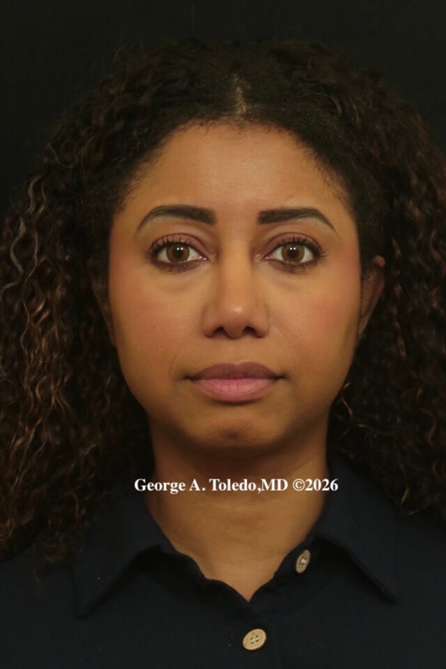 Ethnic Rhinoplasty Dallas After