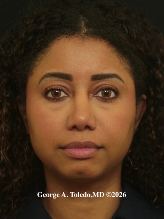Ethnic Rhinoplasty Dallas After