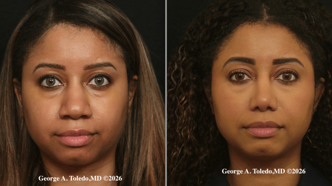 Ethnic Rhinoplasty