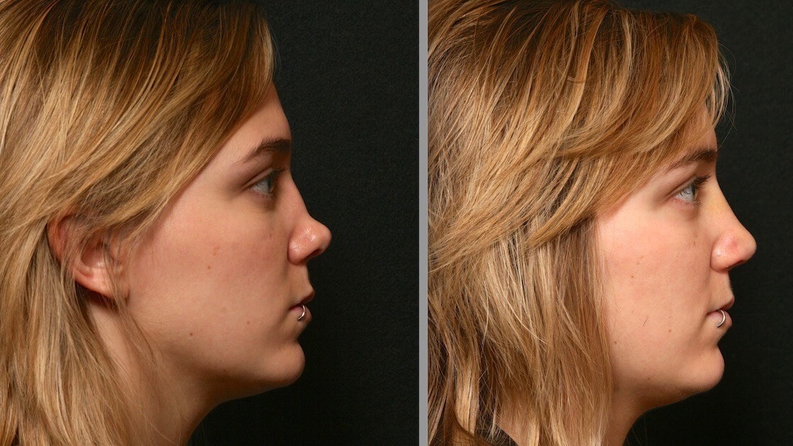 Revision Rhinoplasty