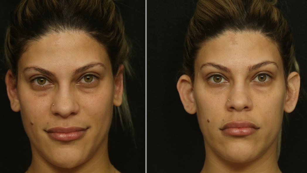 Otoplasty Female