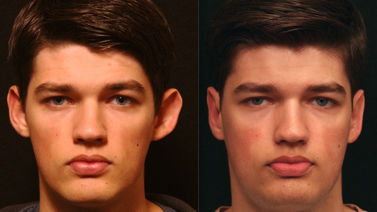 Otoplasty Male