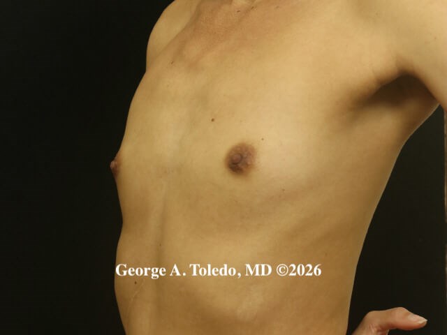 Breast Implant Results Dallas Before