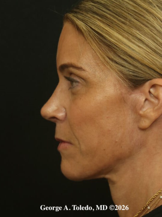 Facelift & Rhinoplasty Dallas After