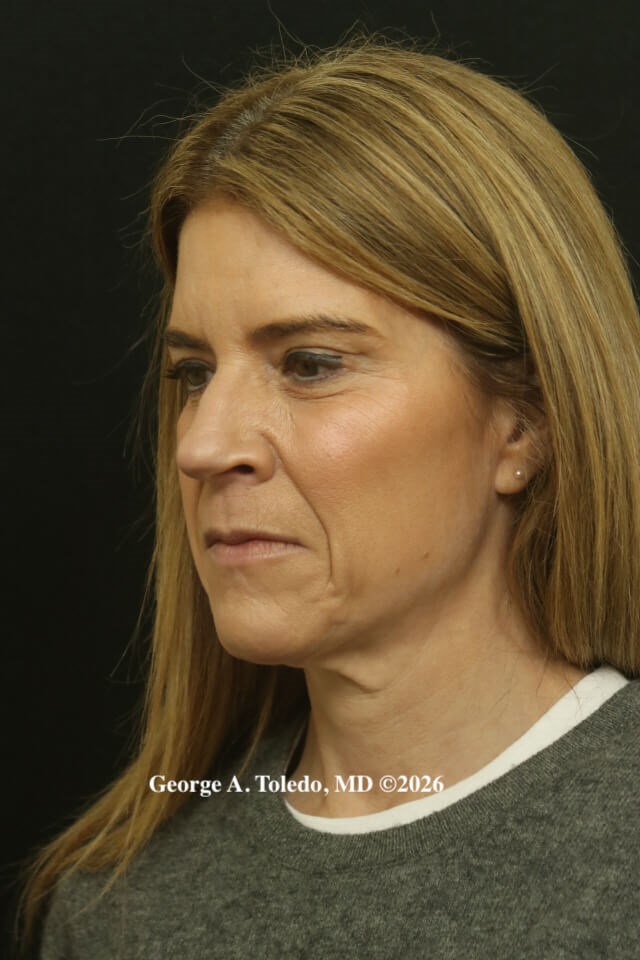 Facelift & Rhinoplasty Dallas Before