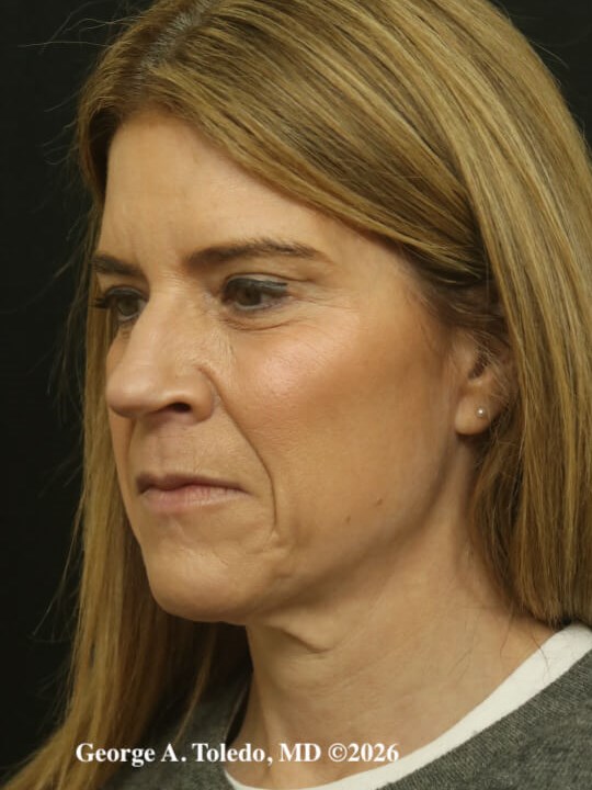 Facelift & Rhinoplasty Dallas Before