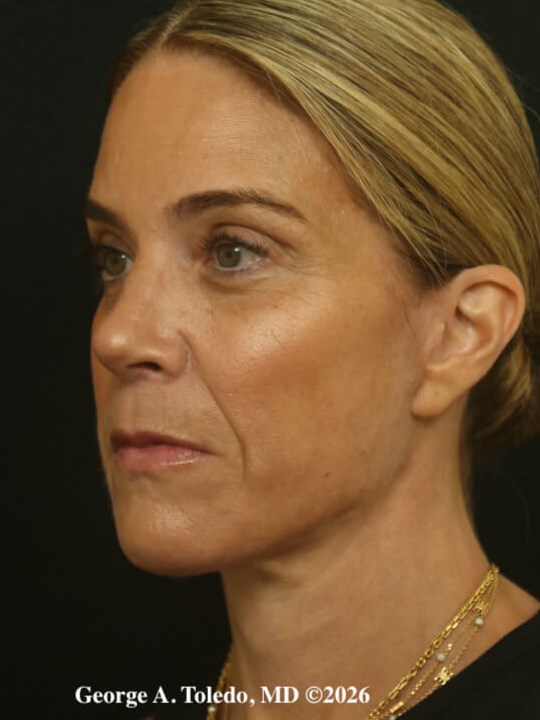 Facelift & Rhinoplasty Dallas After