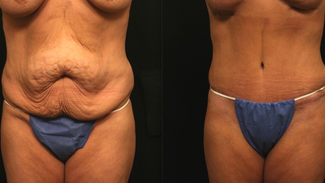 Tummy Tuck Front Results