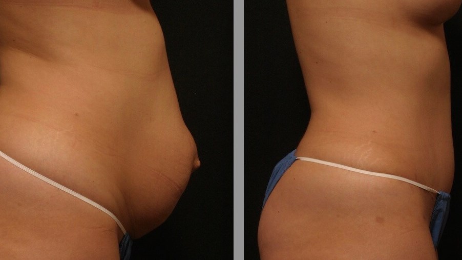Tummy Tuck Profile Results