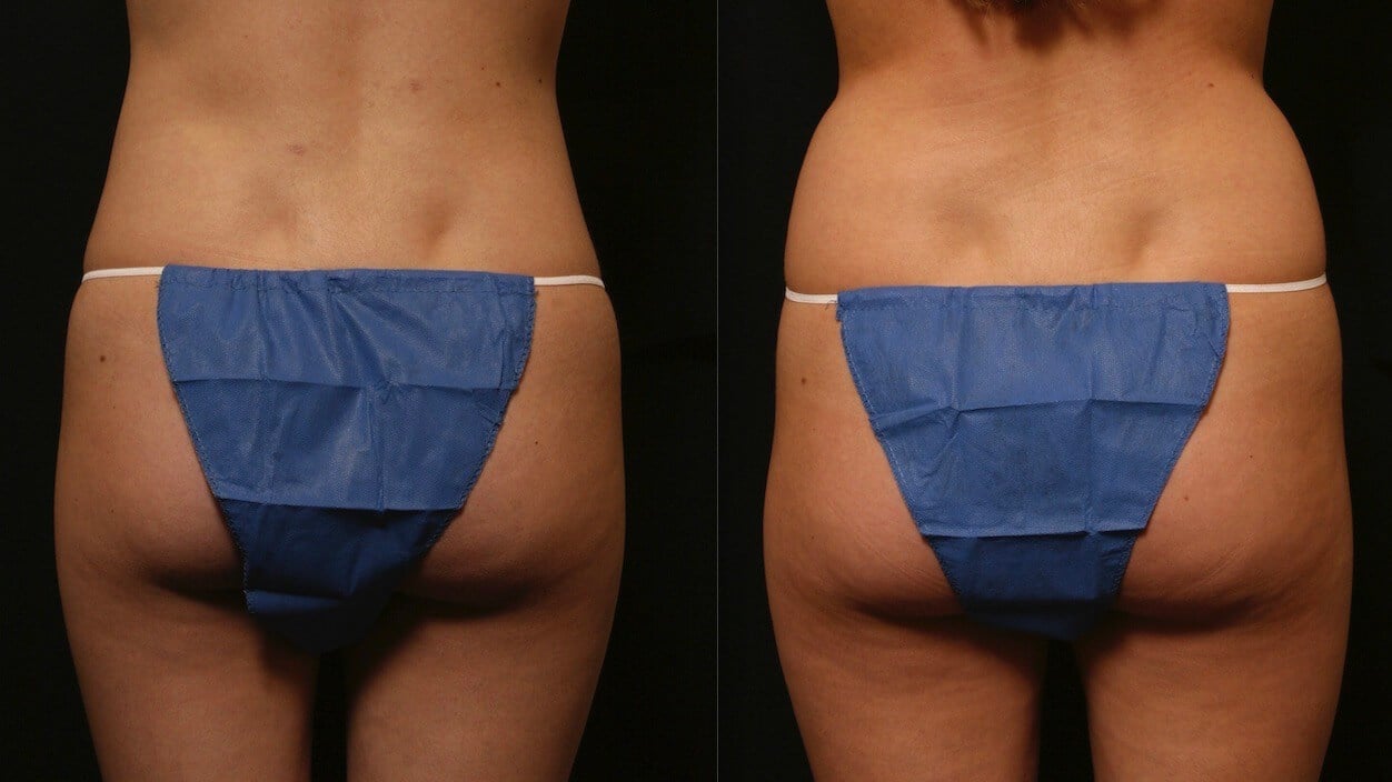 Liposuction Results