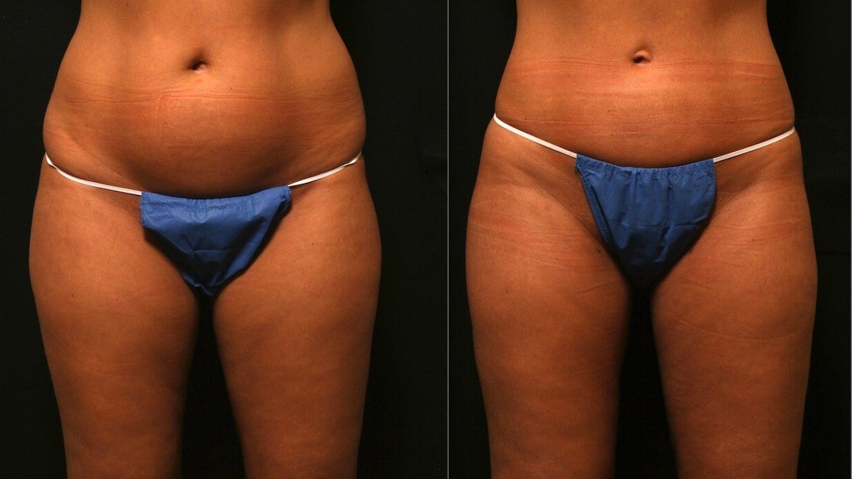 Liposuction Results