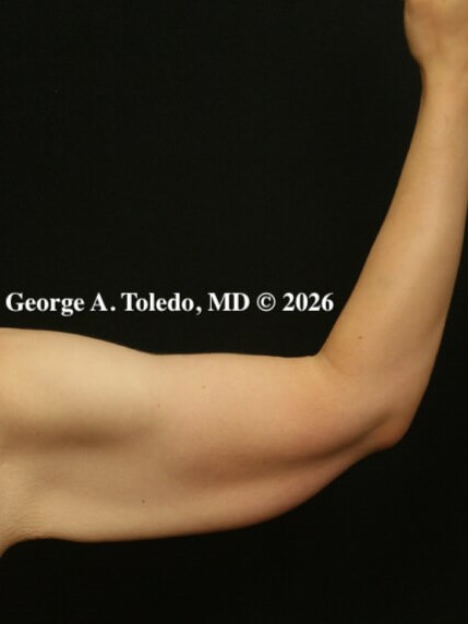 Arm Lift Before and After Before