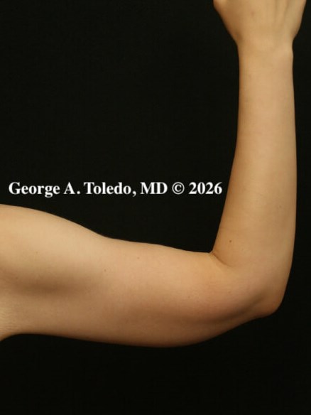 Arm Lift Before and After After